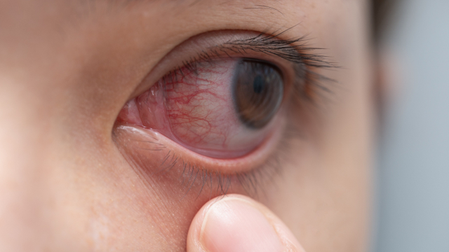 Ilustrasi Mata Merah. Foto: Shutterstock