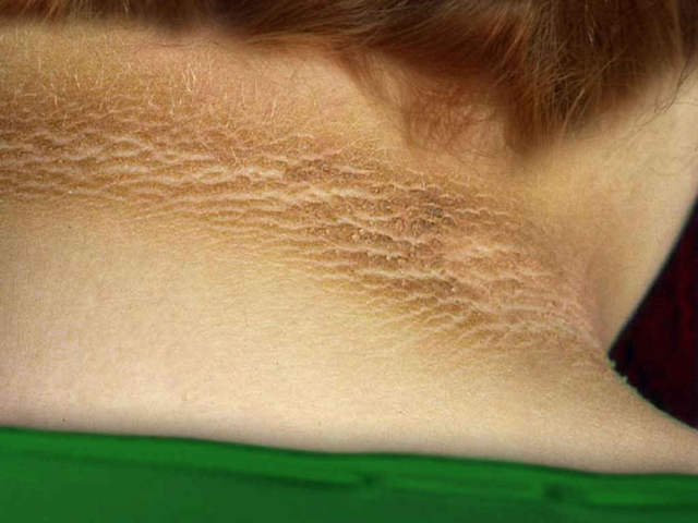 Acanthosis nigricans. Foto: Scott Dulebohn (CC BY SA 4.0)