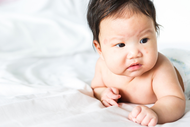 Komplikasi yang Bisa Ditimbulkan Bisul pada Bayi. Foto: Shutter Stock