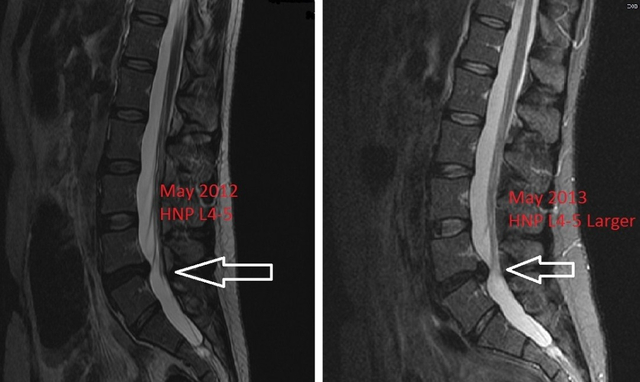 Ilustrasi kode icd 10 hnp. Foto: Dok. Eka Hospital