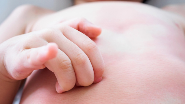 Cara Atasi Kulit Kering pada Anak  Foto: Shutterstock