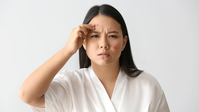 Cara Atasi Jerawat saat Hamil Foto: Shutterstock