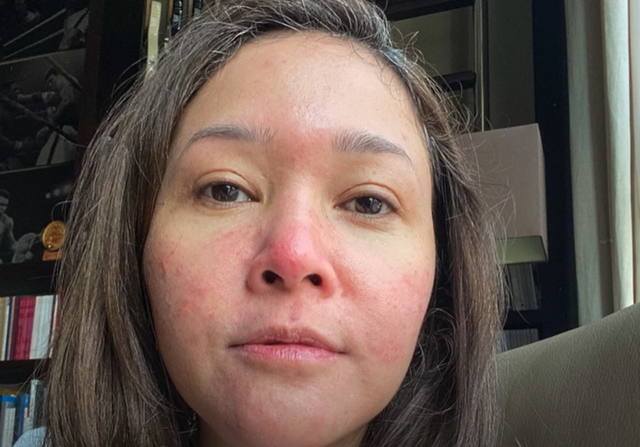 Kondisi kulit Maia Estianty saat mengalami Rosacea. Dok. Youtube Maia Aleldul TV.