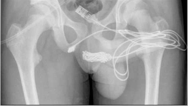 Kabel USB yang nyangkut di penis pasien. Foto: Loufopoulos, et.al, Urology Case Report, 2021