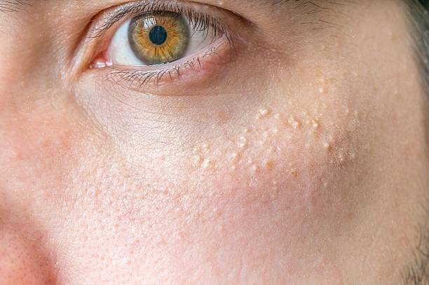 Cara Menghilangkan Milia di Wajah. Foto: iStockphoto