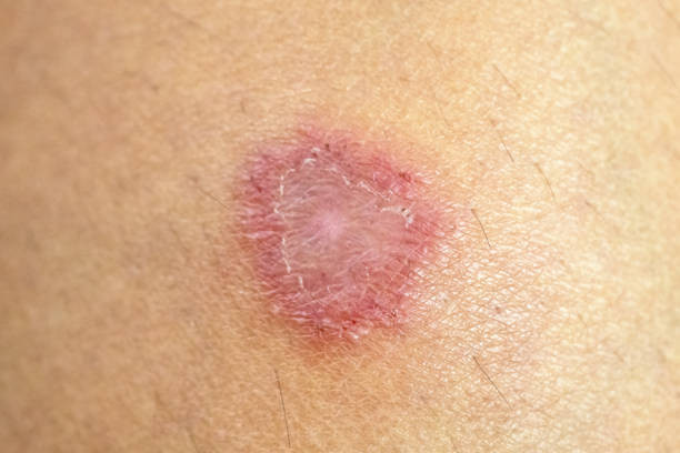 Ilustrasi fungal acne. Foto: Unsplash