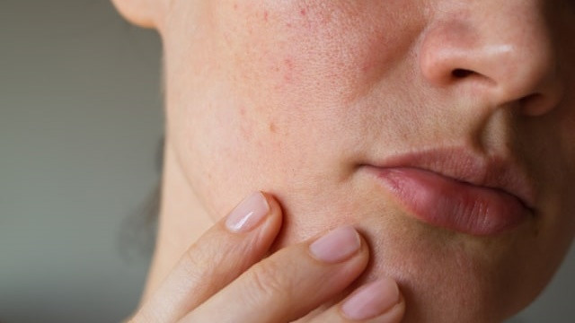 Ilustrasi kulit sensitif. Foto: Shutterstock