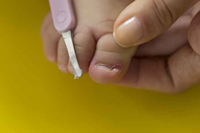 Ilustrasi kuku yang rusak akibat jamur. Foto: Pixabay