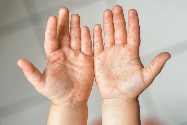 Ilustrasi Anak Kena Flu Singapura atau Penyakit Tangan, Kaki, Mulut (PTKM). Foto: Shutterstock