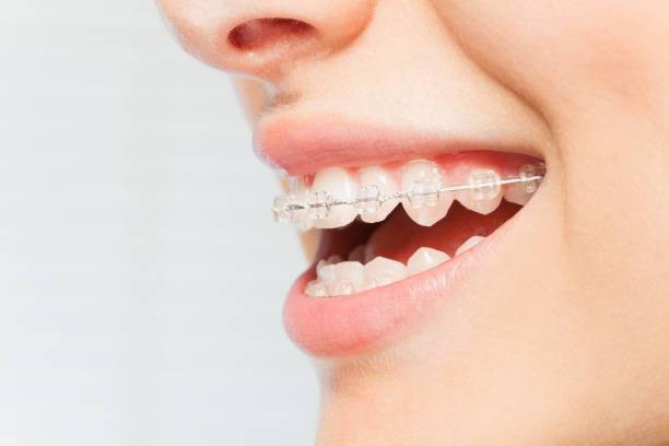 Contoh Pemakaian Behel. (Sumber foto: Pixabay.com)