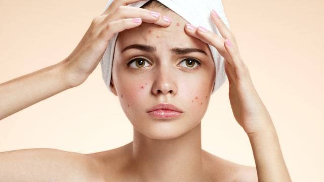Ilustrasi kulit wajah mengalami purging. Foto: Shutterstock