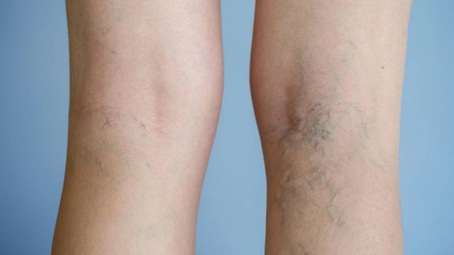 Ilustrasi Varises (Foto: Dok. Thinkstock)