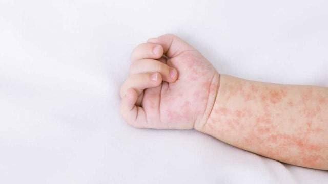 Ilustrasi penyakit campak. Foto: pixabay