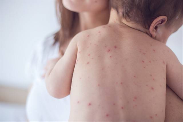 Ilustrasi kemunculan ruam yang disebabkan oleh infeksi virus rubella. Foto: Pixabay