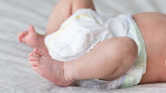 Ilustrasi kulit bayi baru lahir mengelupas. Foto: UvGroup/Shutterstock