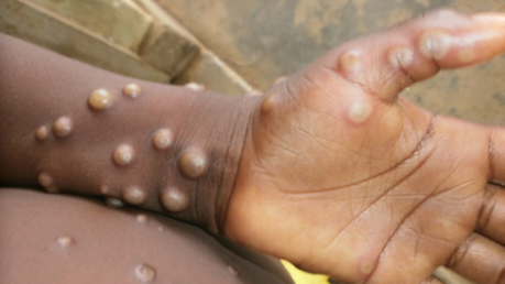 Ilustrasi gejala cacar monyet. Foto: WHO