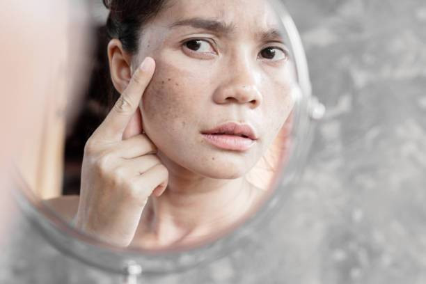 Hiperpigmentasi. Foto: iStockphoto