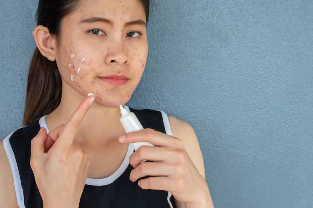 Cara Pemakaian Dark Spot Serum Ms Glow. Foto: iStockphoto