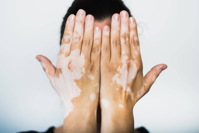 Ilustrasi perempuan vitiligo. Foto: Shutterstock