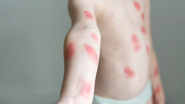 Ilustrasi Cacar Monyet atau Monkeypox. Foto: Yulia Naumenko/Shutterstock