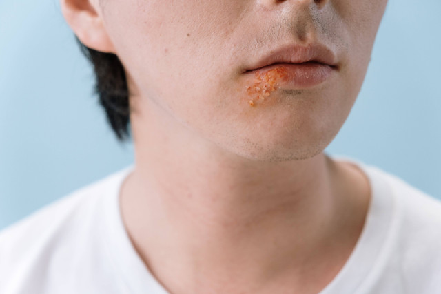 Cacar monyet adalah penyakit yang disebabkan oleh infeksi virus Monkeypox. Foto: Unsplash.com
