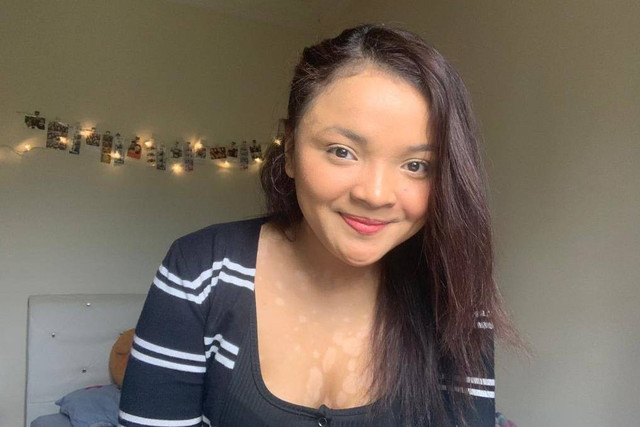 Maria Claudia, pejuang masalah kulit psoriasis. Foto: Dok. Pribadi