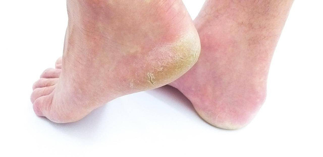 Kaki pecah-pecah adalah kondisi ketika kulit pada tumit menebal dan muncul retakan di atasnya. Foto: Pixabay.com