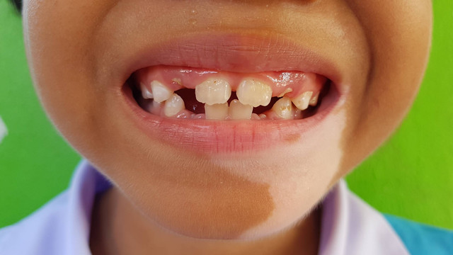 Ilustrasi hipopigmentasi di wajah anak. Foto: jeezjazz/Shutterstock