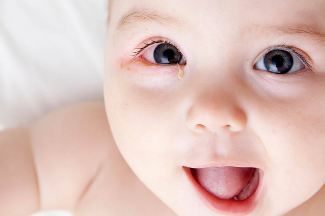 Ilustrasi kemerahan di mata bayi. Foto: Shutterstock