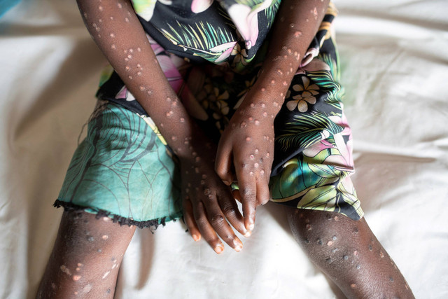 Angelika Lifafu (6) diduga menderita cacar monyet, duduk di tempat tidur di Puskesmas Yalolia, Tshopo, Republik Demokratik Kongo,Senin (3/10/2022). Foto: Arlette Bashizi/Reuters
