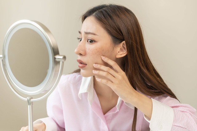 Lebih dari 90% penderita melasma adalah perempuan, ini penyebabnya. Foto: Shutterstock