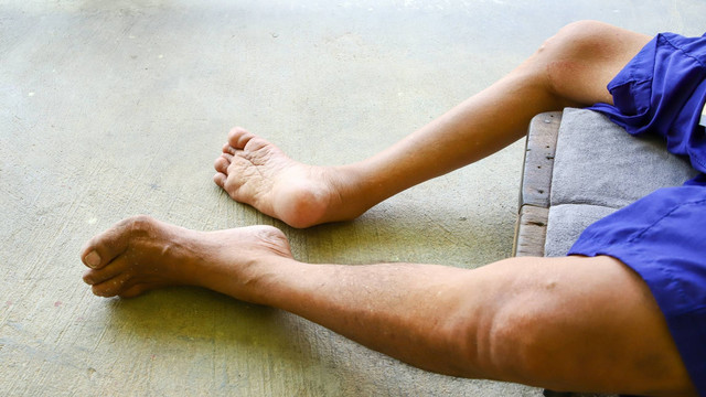 Ilustrasi polio. Foto: podsy/Shutterstock