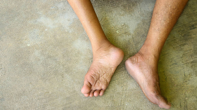 Ilustrasi polio. Foto: podsy/Shutterstock