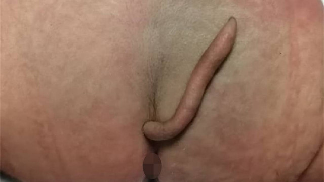 Bayi di Nuevo Leon, Meksiko, ini lahir dengan ekor sepanjang 5,7 cm. Foto: Josue Rueda, dokter dari Hospital Universitario Dr. José Eleuterio González, dkk via Journal of Paediatric Surgery Case Reports