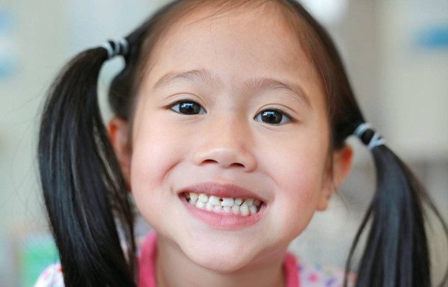 Bercak kuning pada gigi anak disebabkan oleh banyak faktor. Foto: Shutterstock.com