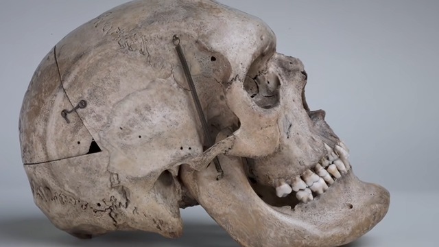 Kepala Charles Byrne, manusia raksasa dari Irlandia.  Foto: YouTube/Ronan McCloskey