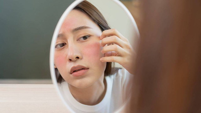Ilustrasi kemerahan pada wajah. Foto: Shutterstock.com