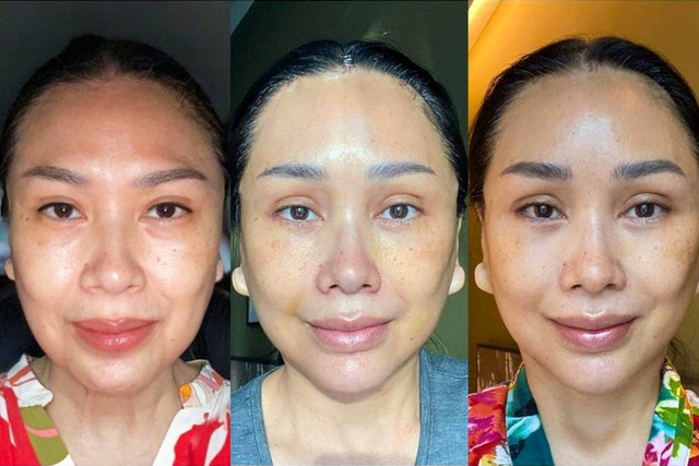 Transformasi operasi plastik Titi DJ di Korea Selatan. Foto: Instagram/@ti2dj