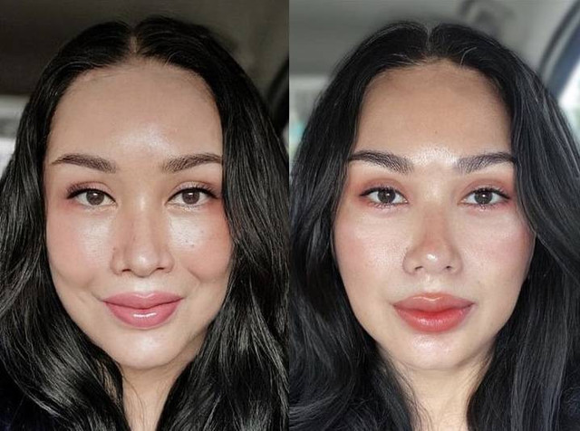 Titi DJ menjalani prosedur operasi plastik anti-aging di Korea Selatan. Foto: Instagram/@ti2dj