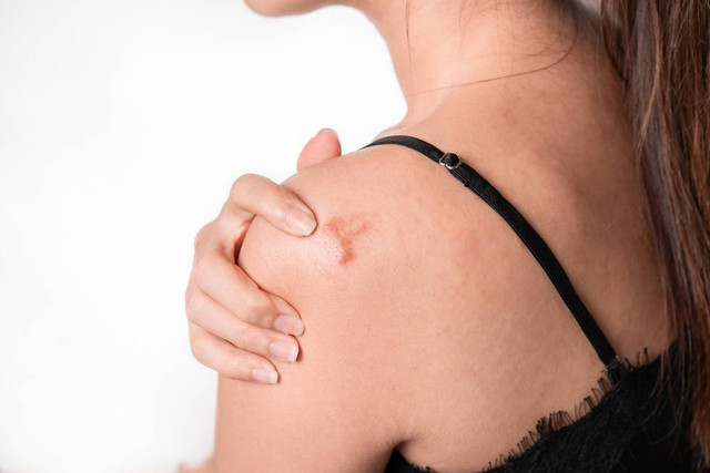 Ilustrasi bekas luka keloid yang sulit hilang. Foto: Shutterstock