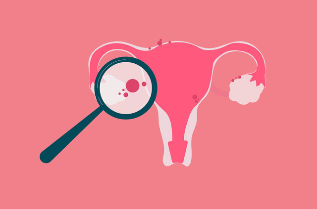 Ilustrasi endometriosis. Foto: Gegambar/Shutterstock