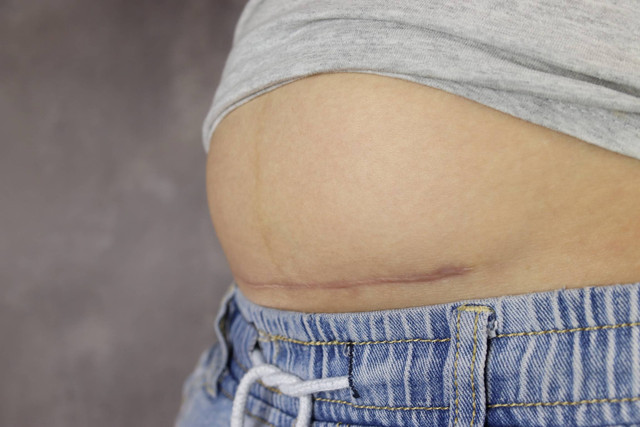 Waspada! Ini Tanda-tanda Jahitan Operasi Caesar Infeksi. Foto: Seamm/Shutterstock