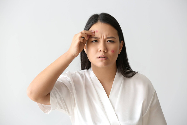 Jerawat pada ibu hamil. Foto: Aquarius Studio/Shutterstock