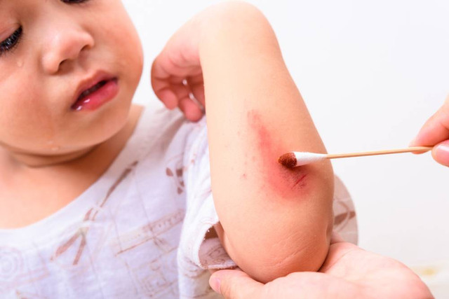 Ilustrasi menangani luka anak. Foto: Sorapop Udomsri/Shutterstock
