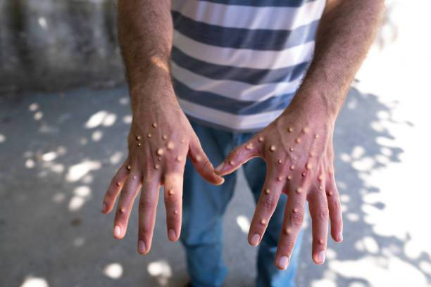 Bentuk fisik yang terpapar virus Monkeypox. Foto : iStock