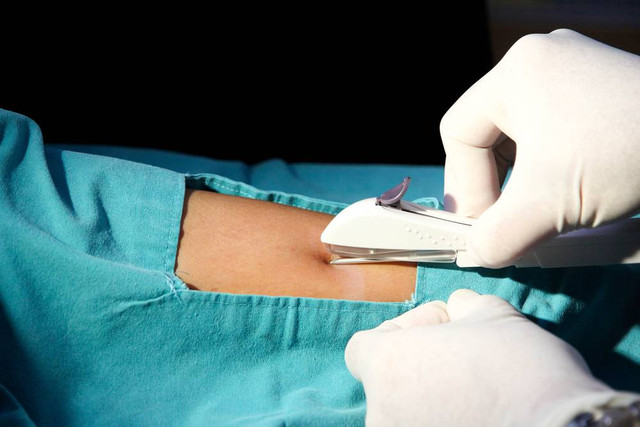 Ilustrasi kontrasepsi: KB implan Foto: Akkalak Aiempradit/shutterstock