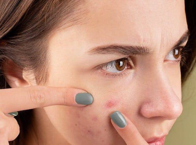 Ilustrasi kegunaan acne patch. Foto: Pexels/Anna Nekrashevich