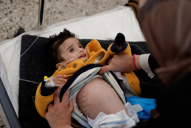 Bocah Palestina Ahmed Qannan, yang menderita kekurangan gizi. Foto: Mohammed Salem/REUTERS