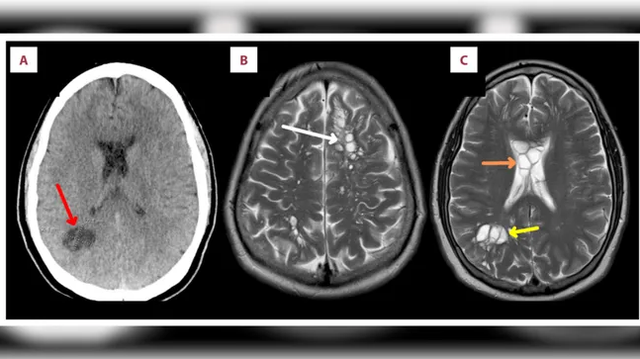 Pemindaian otak pasien mengungkapkan bahwa ia memiliki banyak lesi larva cacing pita babi yang tumbuh di sejumlah bagian otaknya. Foto: American Journal of Case Reports