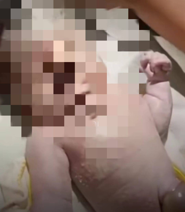 Potongan bayi bermata satu yang lahir di RSUD Sekayu Muba